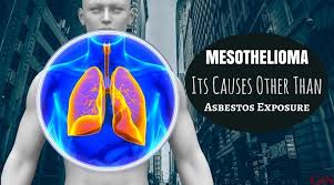 proton therapy for mesothelioma