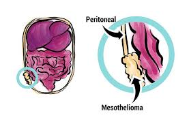 immunotherapy for mesothelioma cost