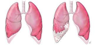 treatment for mesothelioma lung cancer