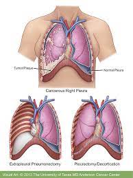 malignant pleural mesothelioma radiology