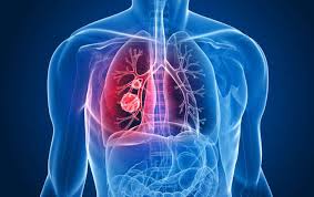 latest treatment for mesothelioma