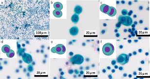 treatment for sarcomatoid mesothelioma