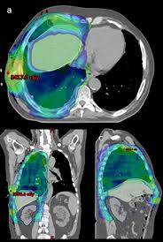 radiation therapy for pleural mesothelioma