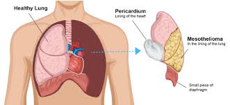 mesothelioma how do you get it