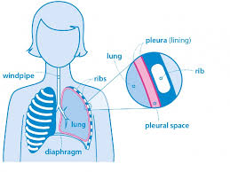 malignant pleural mesothelioma prognosis