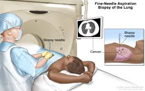 mesothelioma standard of care