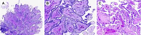 well differentiated papillary mesothelial tumor