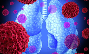 surgery for malignant pleural mesothelioma