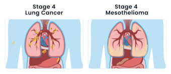 prognosis of stage 4 mesothelioma