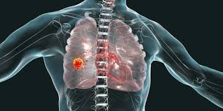 mesothelioma small cell lung cancer