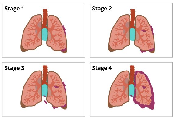 stage 4 malignant mesothelioma