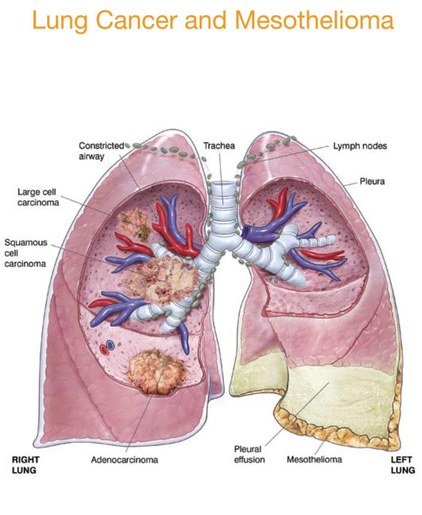 mesothelioma caused by asbestos