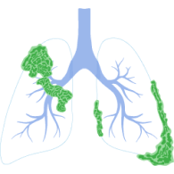 mesothelioma lung cancer survival rate