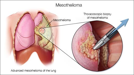 average mesothelioma lawsuit settlements