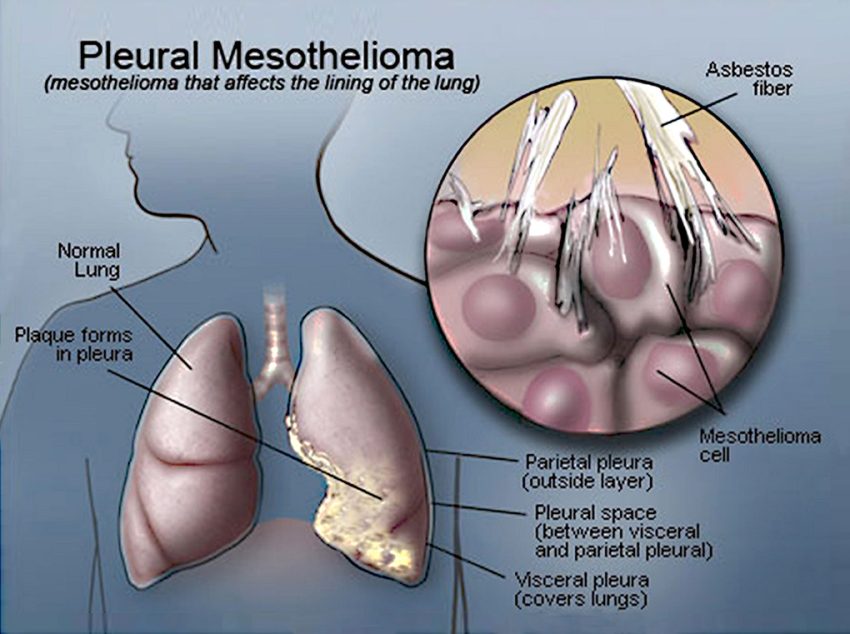 immunotherapy for pleural mesothelioma