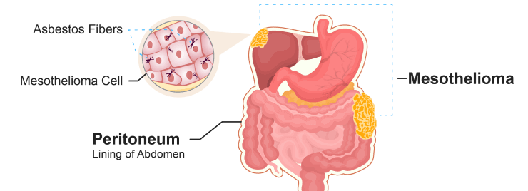 mesothelioma stomach cancer prognosis