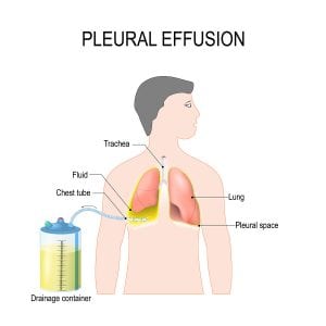 pleural effusion in mesothelioma