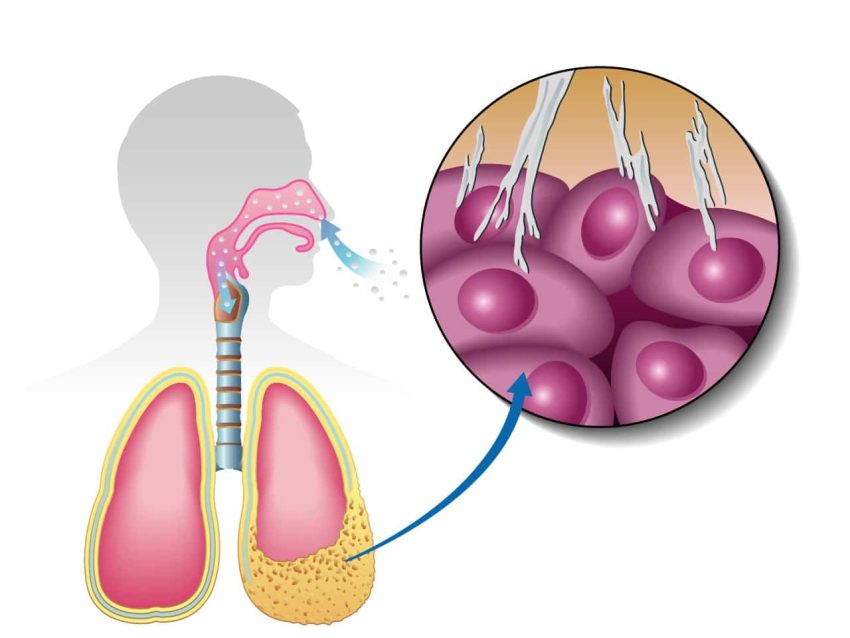 pleural mesothelioma metastasis sites