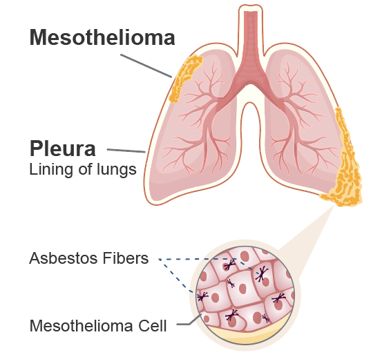 peritoneal mesothelioma not caused by asbestos