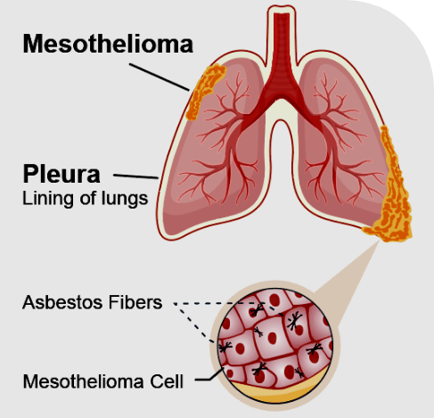 survival rate pleural mesothelioma