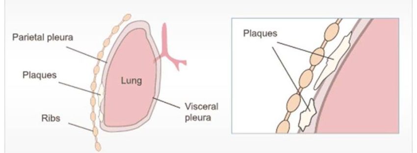 pleural plaques and mesothelioma