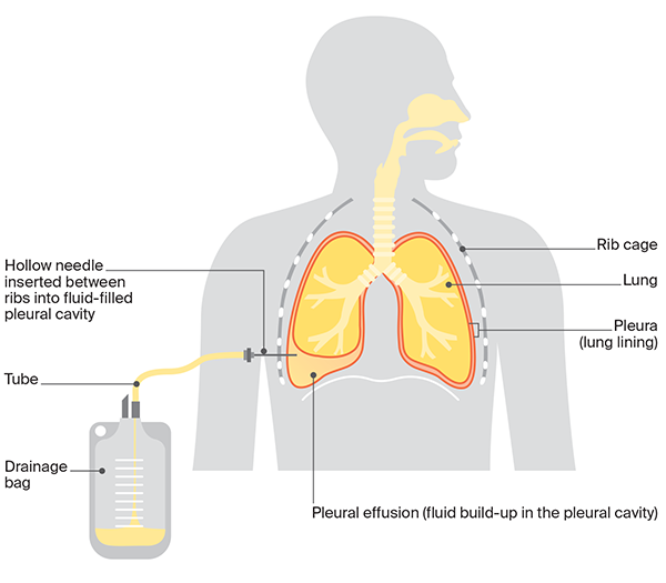 mesothelioma what is it