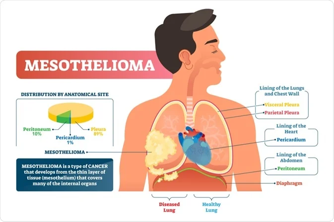 malignant mesothelioma survival rate