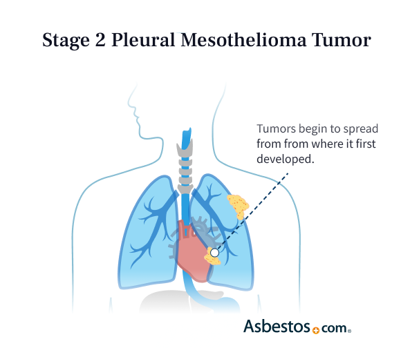 mesothelioma stage 2 survival rate